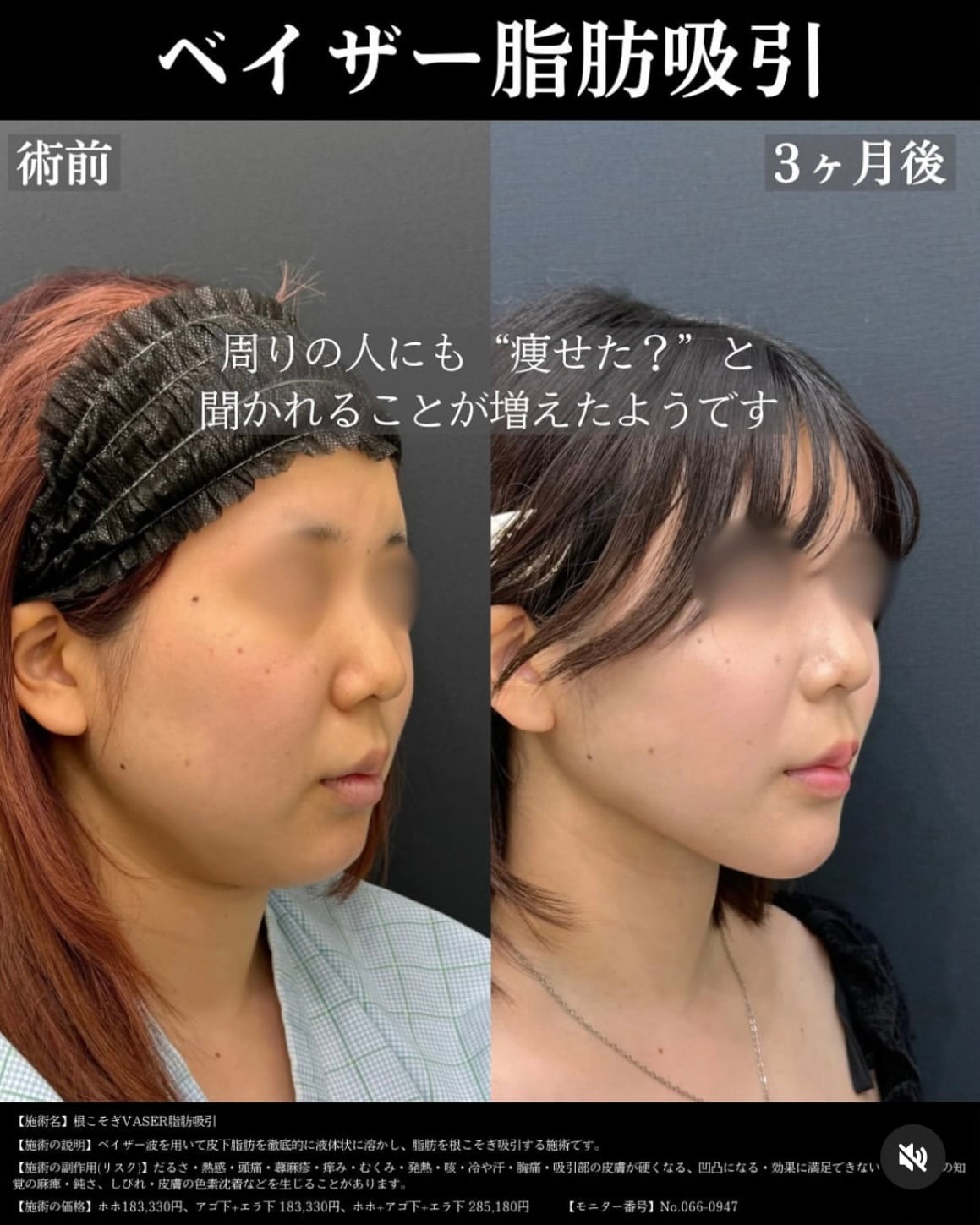 【ベイザー脂肪吸引・頬・あご下・】執刀医・塩入幹汰