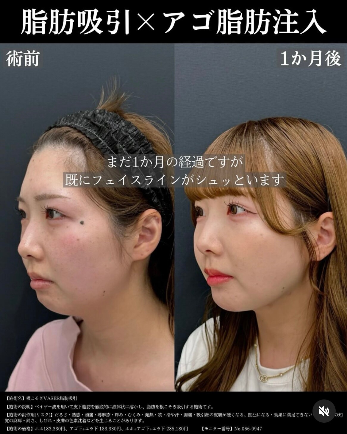 【ベイザー脂肪吸引・頬・あご下+顎の脂肪注入】執刀医・塩入幹汰