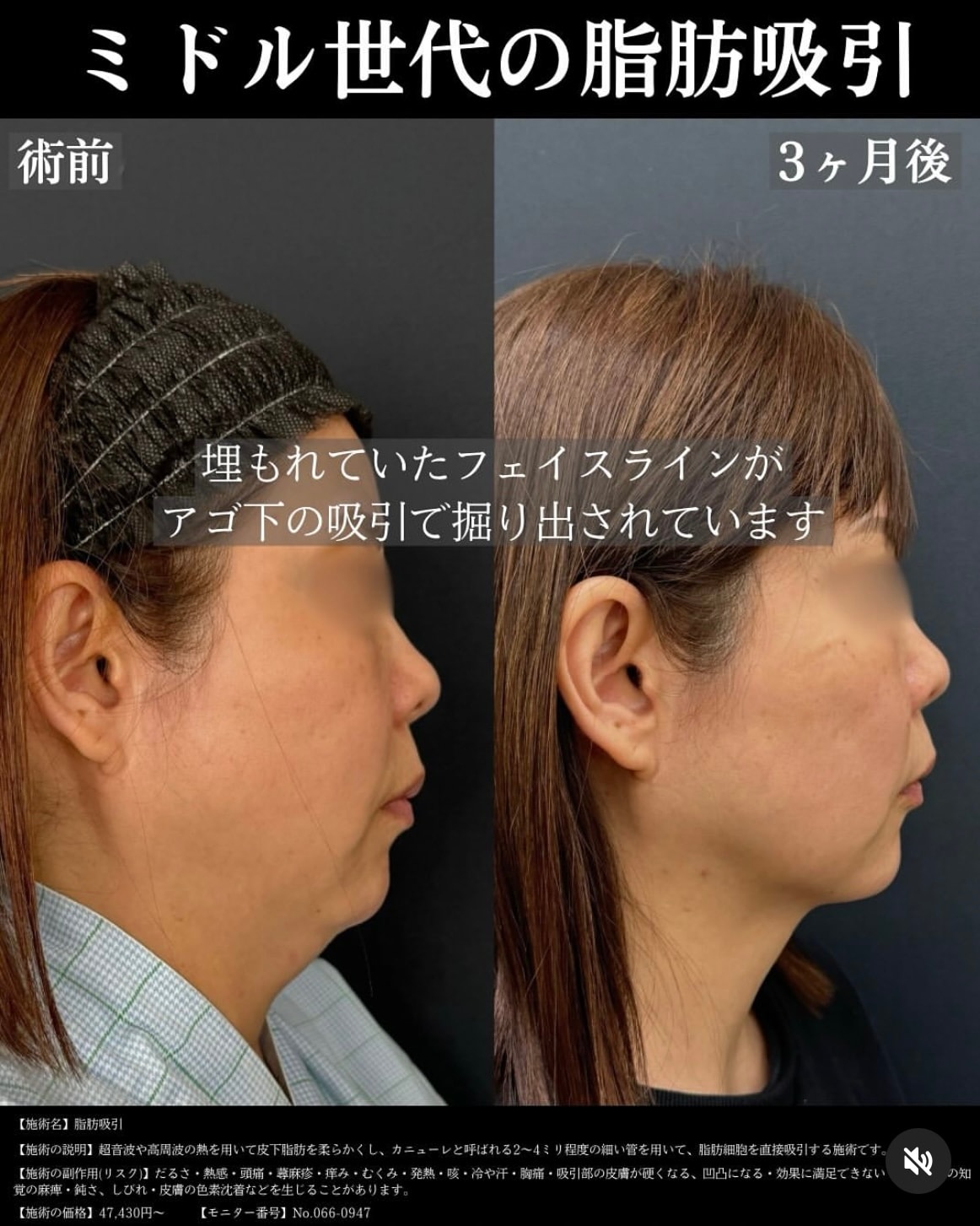 【美ボディ脂肪吸引・頬・あご下】執刀医・塩入幹汰