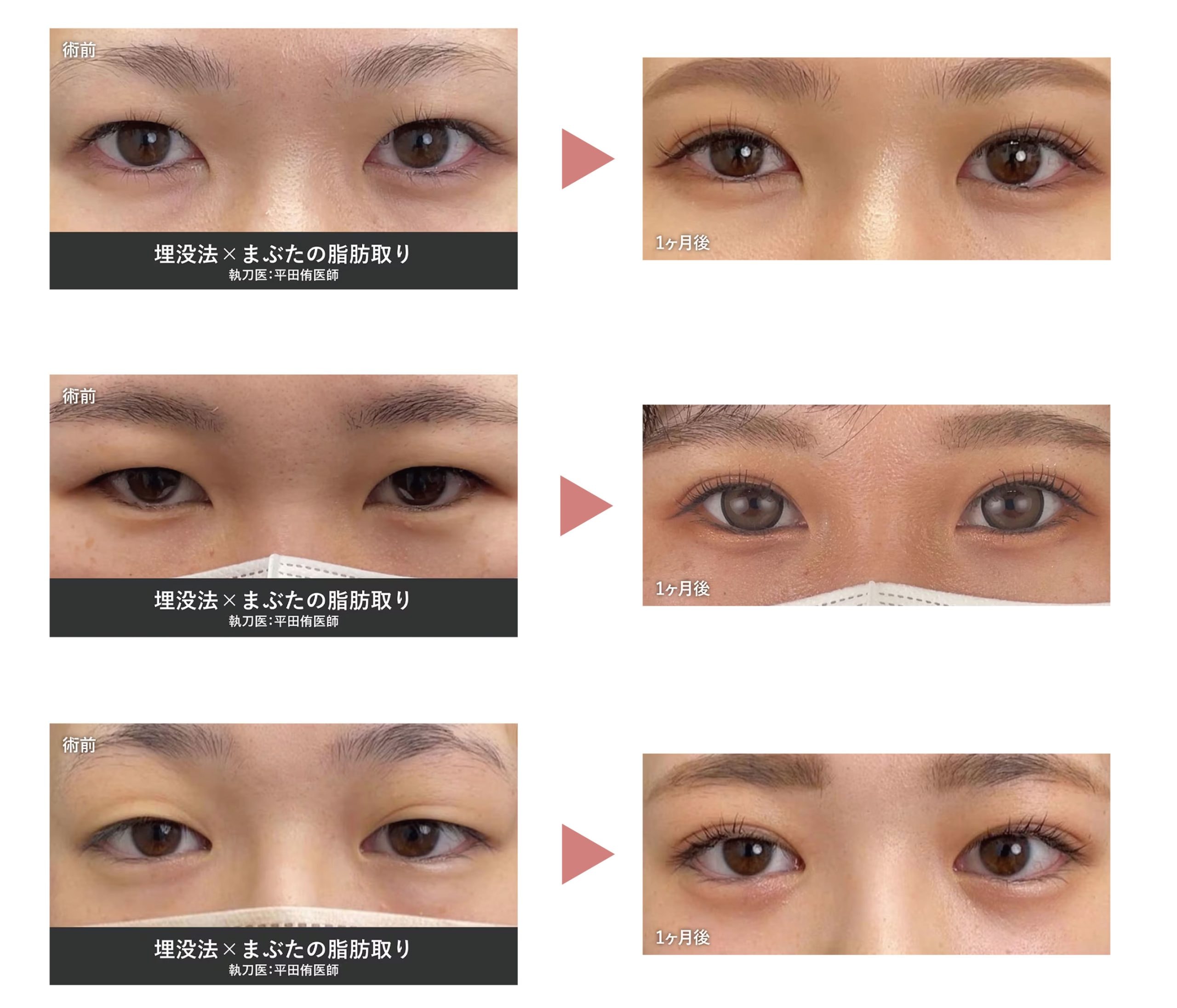 厚いまぶたがスッキリ！自然で美しい二重に