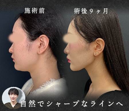 脂肪を減らすだけではない、ミリ単位の引き算が生む美しさ。