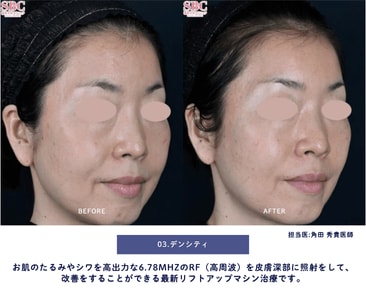 たるみ治療「デンシティ」