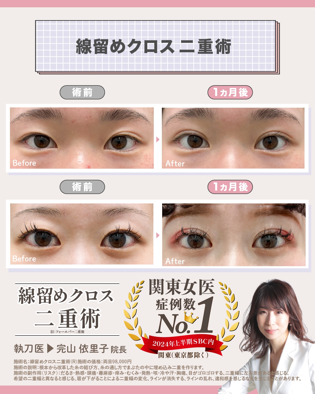 線留めクロス二重術※旧フォーエバー二重術※