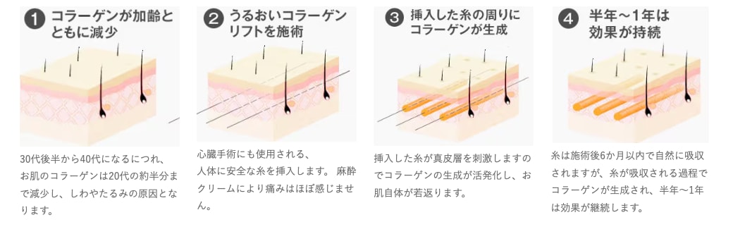 うるコラメカニズム