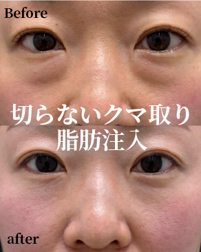 切らないクマとり 全国女医症例数 No.1 2024年下半期 SBC内