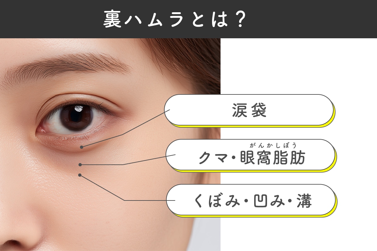 クマ取り裏ハムラ法とは？