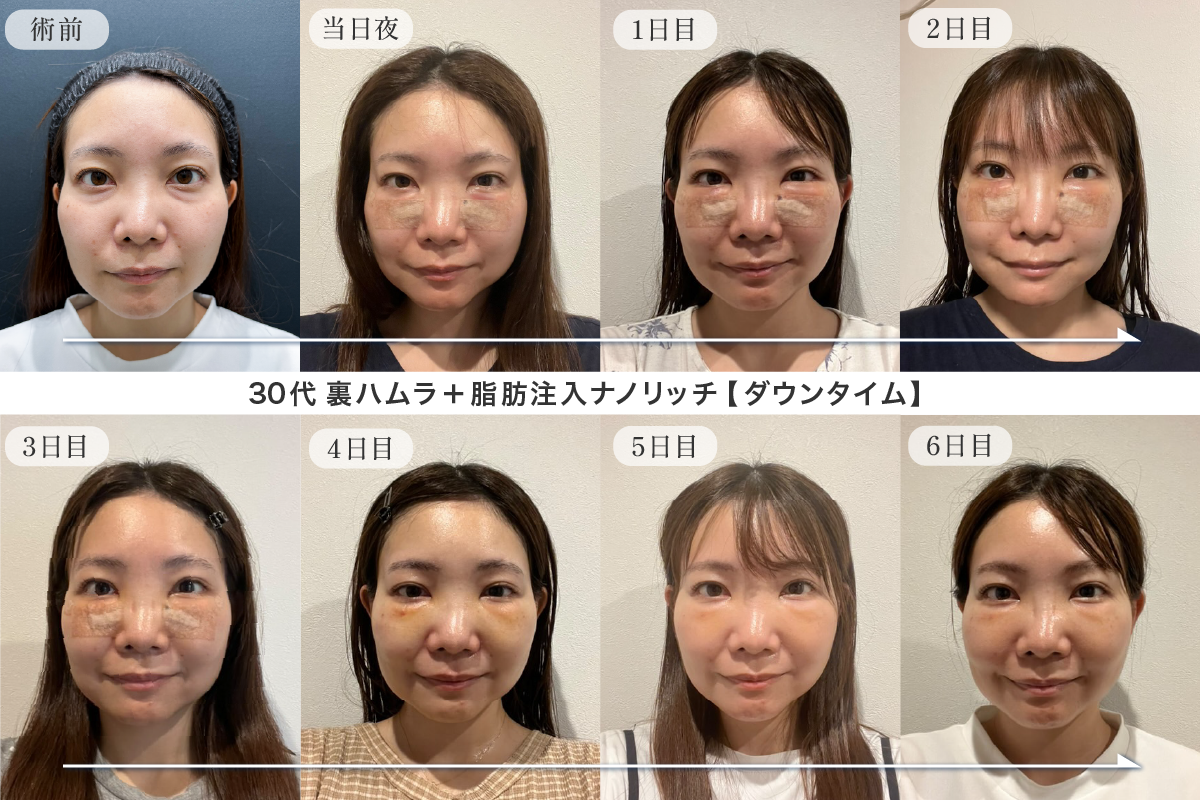 術後１週間のダウンタイムの様子を公開します！