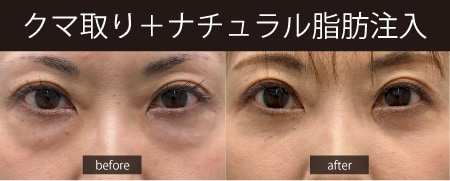 目の下のたるみが消えて自然に若返り
