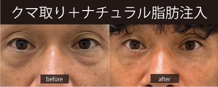 目の下のたるみが取れて目元ぱっちり
