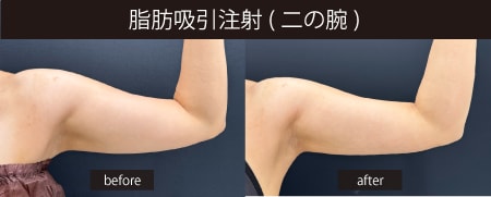 二の腕スッキリ✨