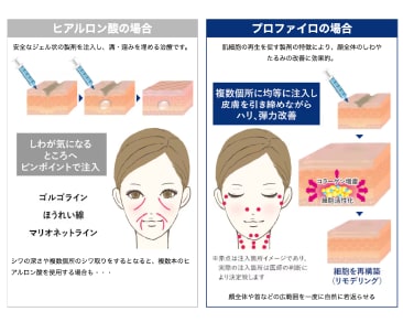 大宮西口院で大人気の次世代ヒアルロン酸【プロファイロ】