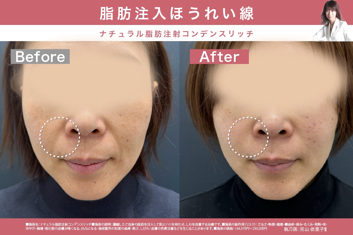 ほうれい線ケア】効果があるのにバレにくい✨最速最短でほうれい線を 