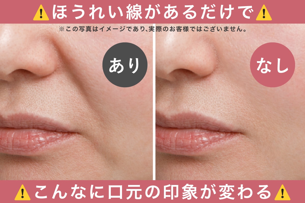 ほうれい線があるだけでこんなに口元の印象が変わります！