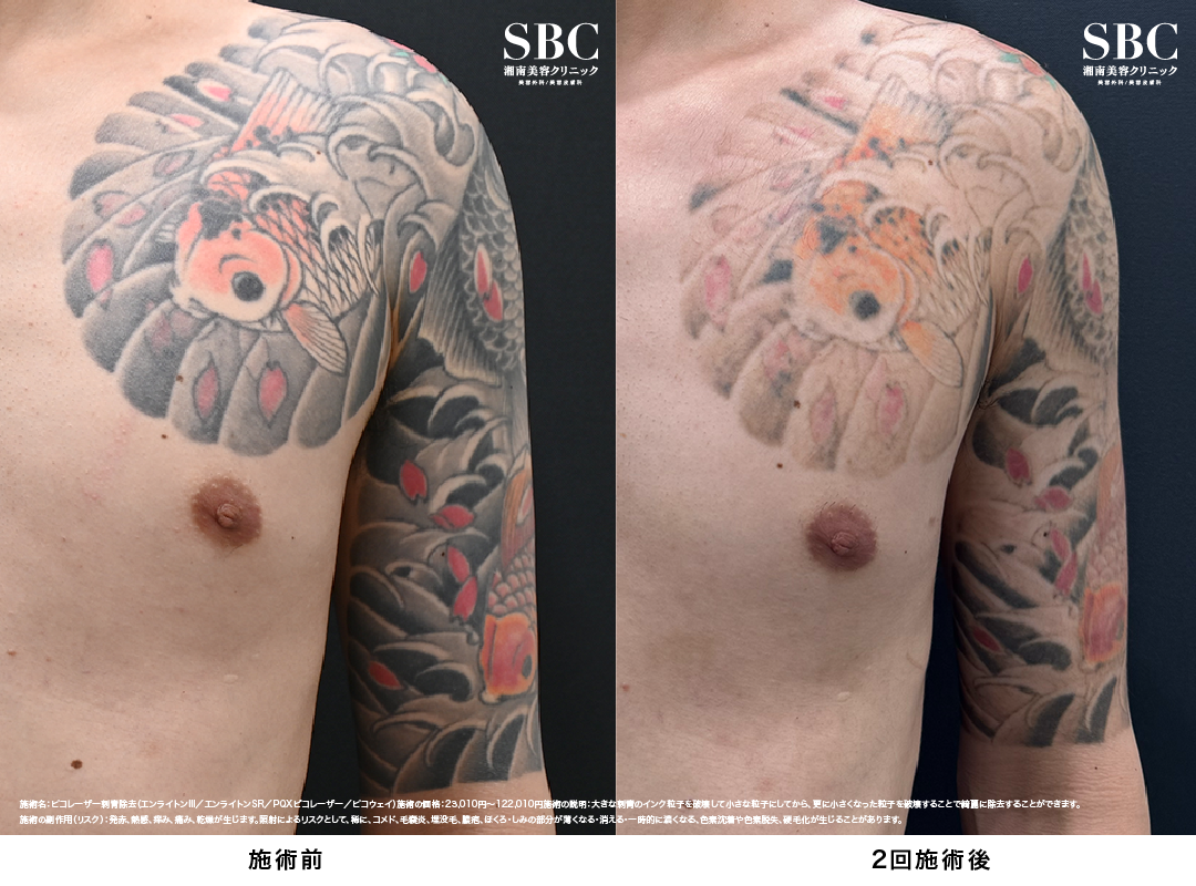 ピコレーザータトゥー除去の症例
