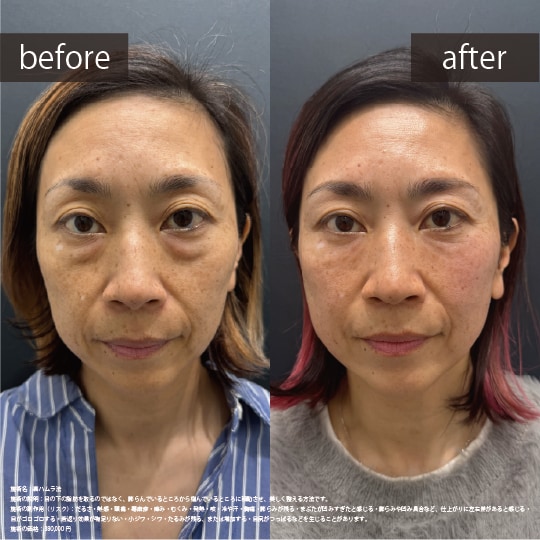 裏ハムラ+脂肪注入(ナノリッチ)