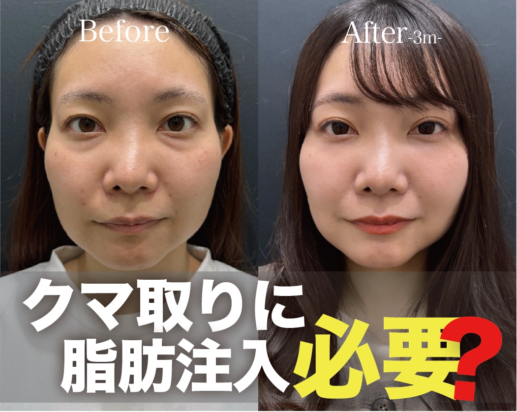 埼玉 大宮でクマ取り&脂肪注入なら【クマ取り名女医】大宮西口院 完山先生にお任せください🪄自然に若返りが叶います✨