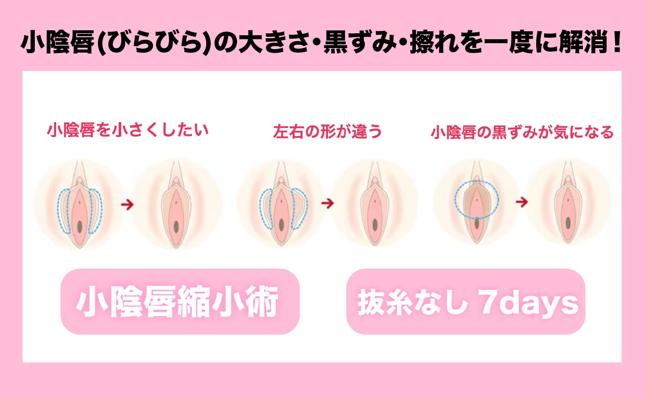 小陰唇(びらびら)の大きさ・左右差・黒ずみ・擦れを一度に解消