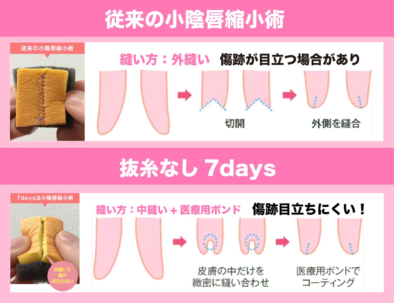 ダウンタイム最小！7DAYS法小陰唇縮小術とは？