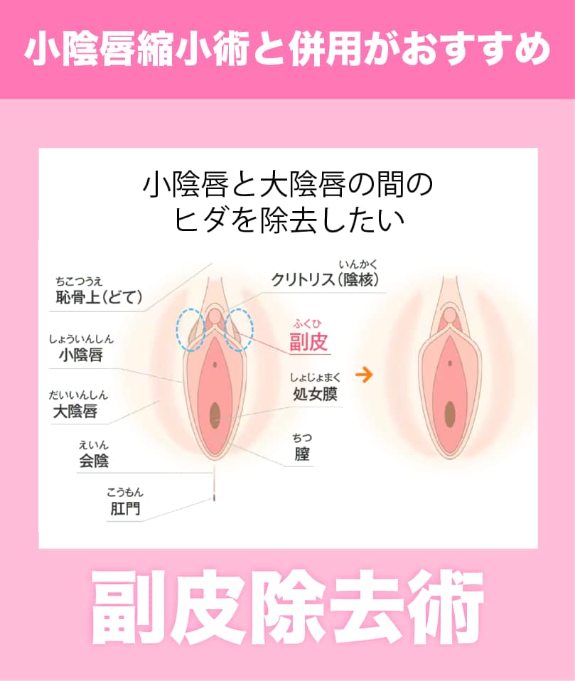 【なぜ小陰唇縮小と副皮除去を同時にやるべきなの？】