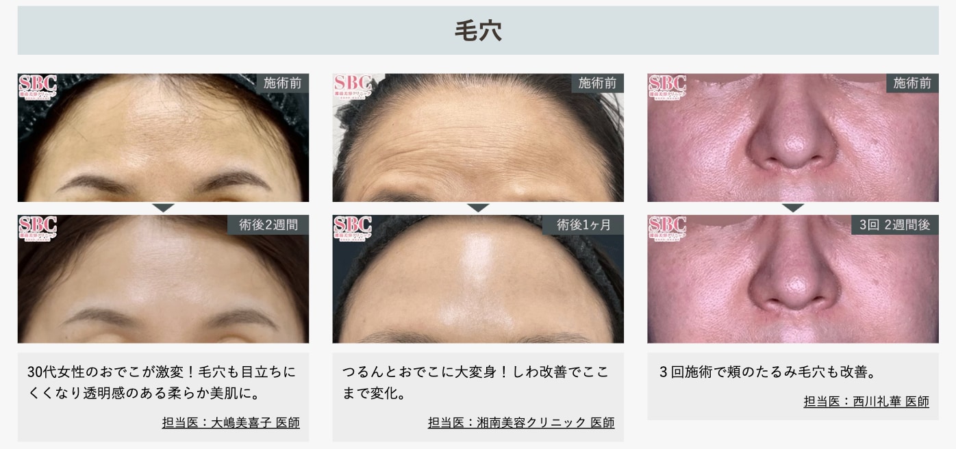 毛穴女優症例