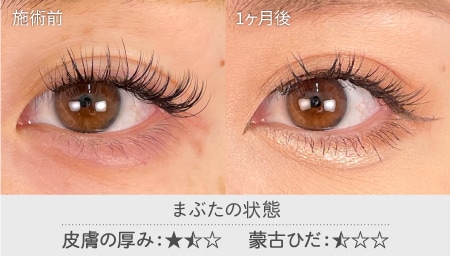 保存版 やす先生が解説 症例写真で見る二重整形の基本 大宮東口院