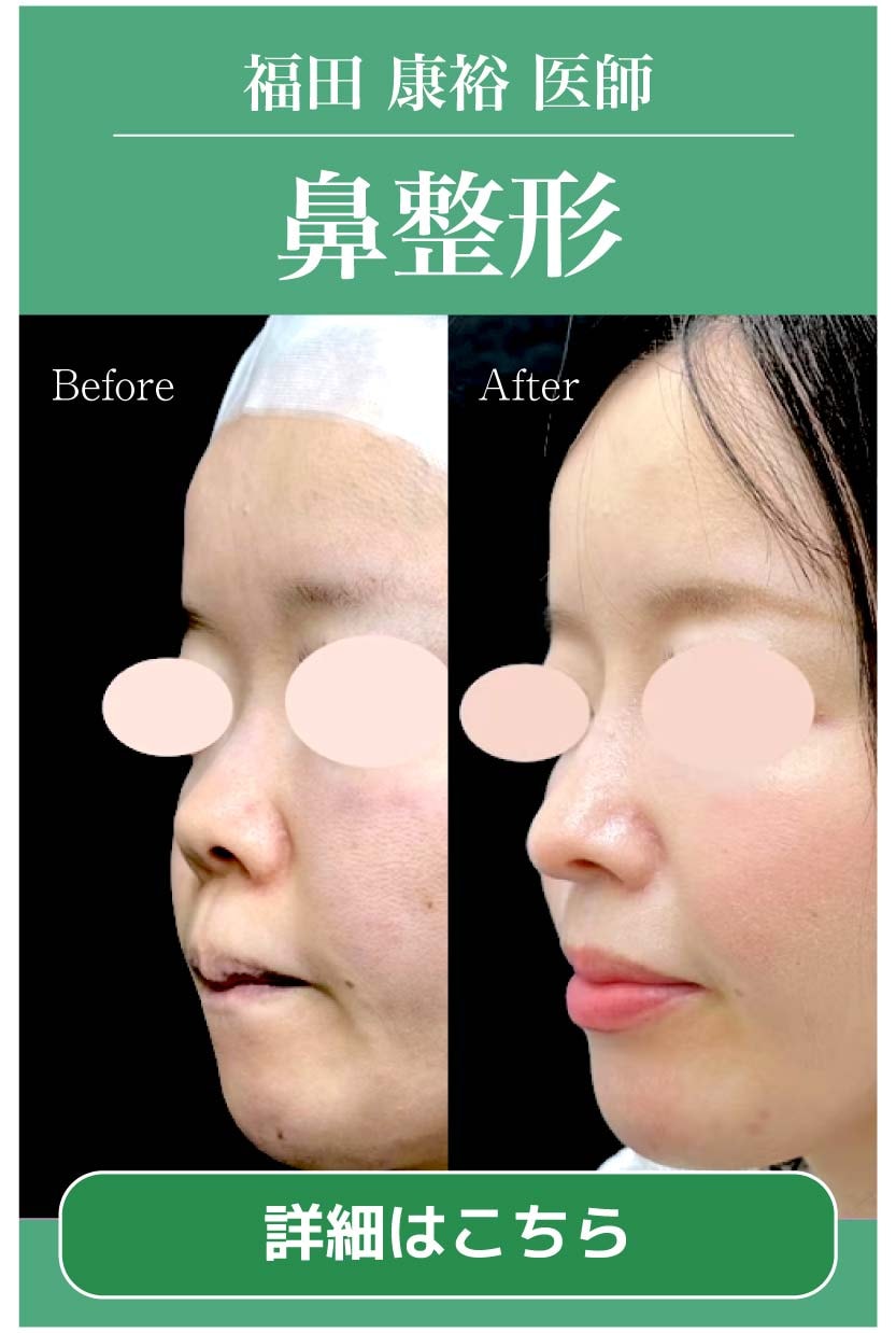 【鼻整形】形成外科専門医の福田院長が担当！やりすぎ感のない自然な仕上がりが大人気♡