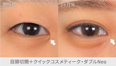 横に大きく | 目頭切開ラインを描きがちなあなたに。
