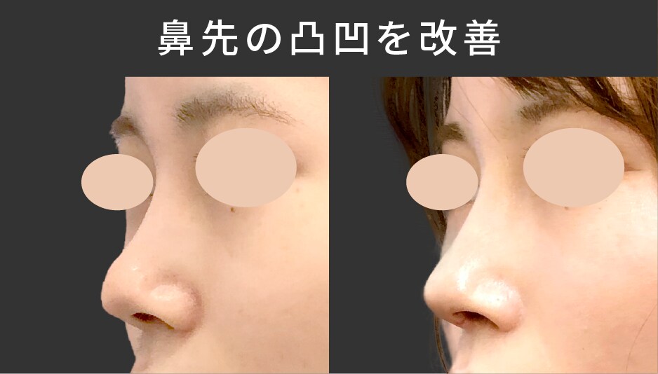 症例4 他院修正をしてほしい<br />
