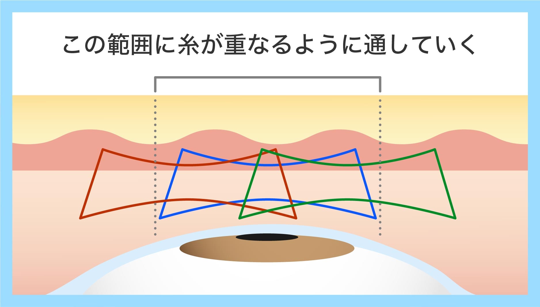 クロスオーバー法とは？