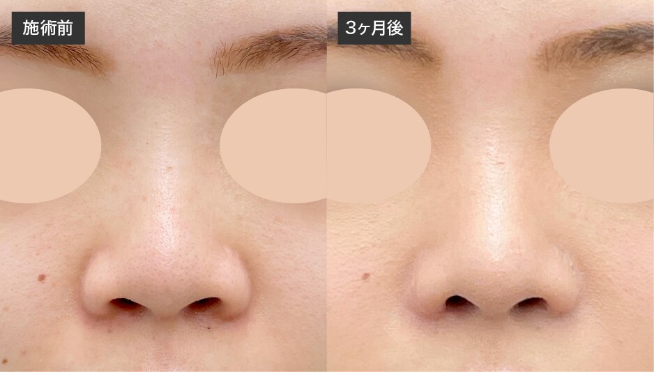 【施術内容】<br />
・鼻中隔延長（鼻中隔軟骨）<br />
・鼻尖形成3D法<br />
・鼻尖部軟骨移植<br />
・鼻プロテーゼ<br />
・小鼻縮小flap法<br />
・他院修正（軽度修正）