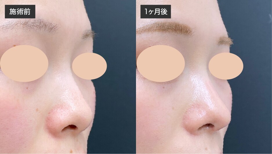 【施術内容】<br />
・鼻中隔延長（鼻中隔軟骨）<br />
・鼻尖形成3D法<br />
・鼻尖部軟骨移植