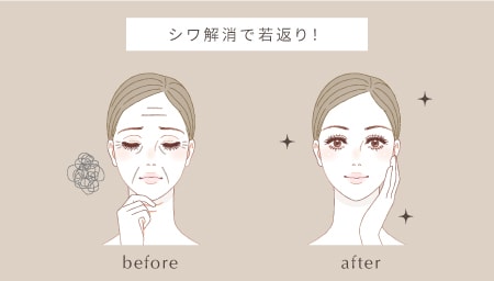 しわ取りで若返り - 40~50代の方に人気です!