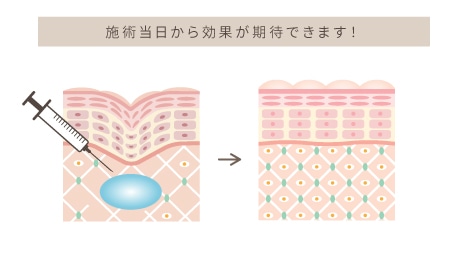 ヒアルロン酸注射で何ができるの?