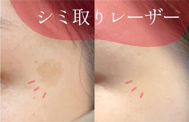 シミ取りレーザー10