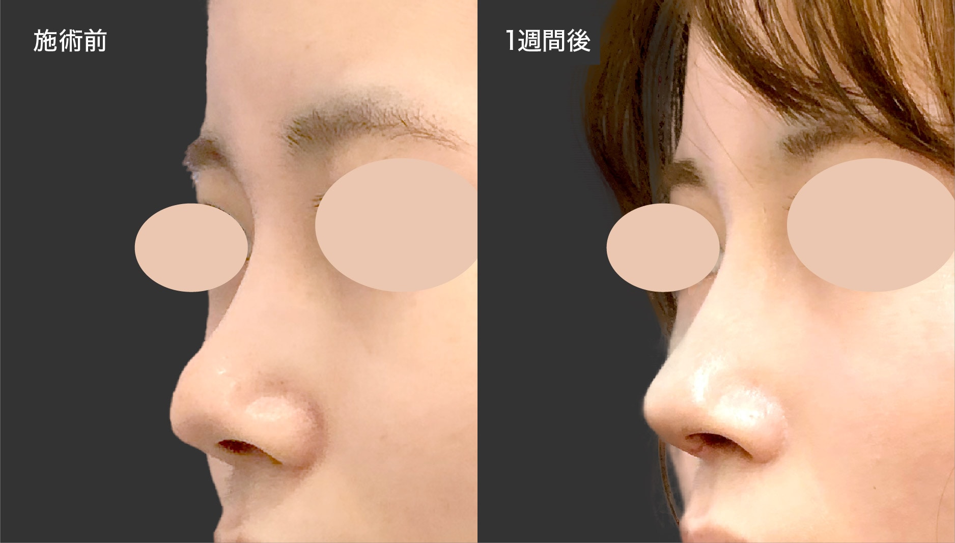 【施術内容】<br />
・オステオポール除去<br />
・鼻中隔延長（鼻中隔軟骨）<br />
・鼻尖形成3D法<br />
・鼻尖部軟骨移植