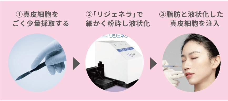 厚労省（日本）・FDA（アメリカ）・CE（ヨーロッパ）認可済。エビデンスのある治療「リジェネラ」で全てのリスクを最小限に。