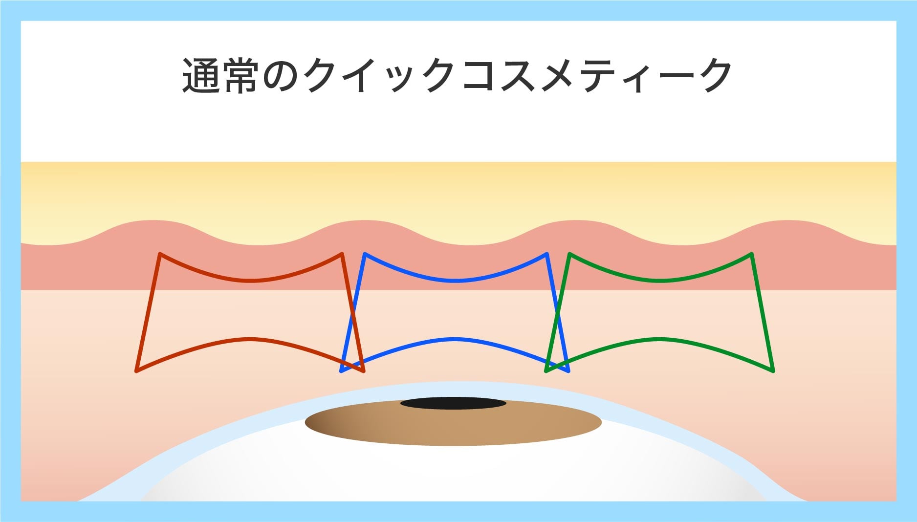 二重ラインを長持ちさせる「クロスオーバー法」