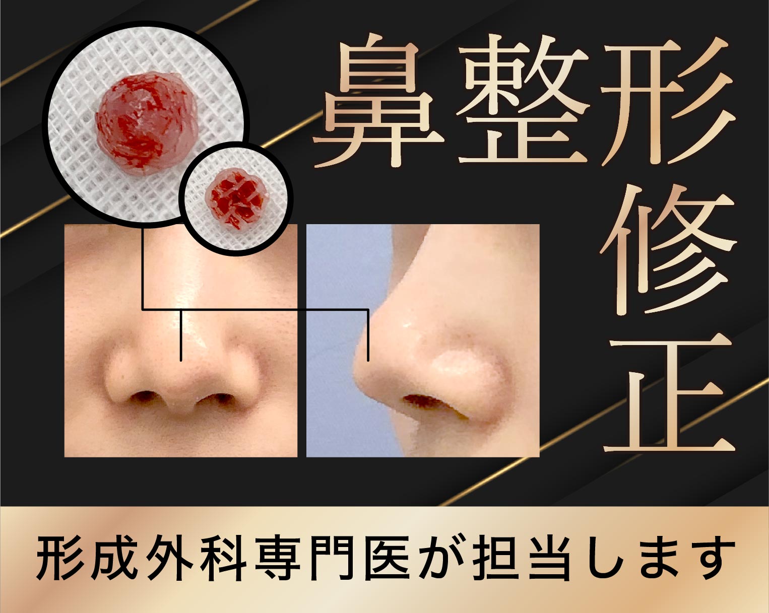 鼻整形の修正を検討中の方へ。大宮には他院修正も担当可能な形成外科専門医が在籍しています。