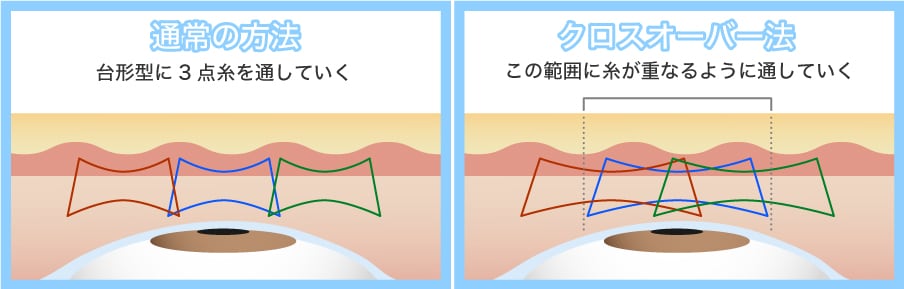 「クロスオーバー法」はクイックコスメティークトリプルを更に取れにくくしたやす先生ならではの縫い方。