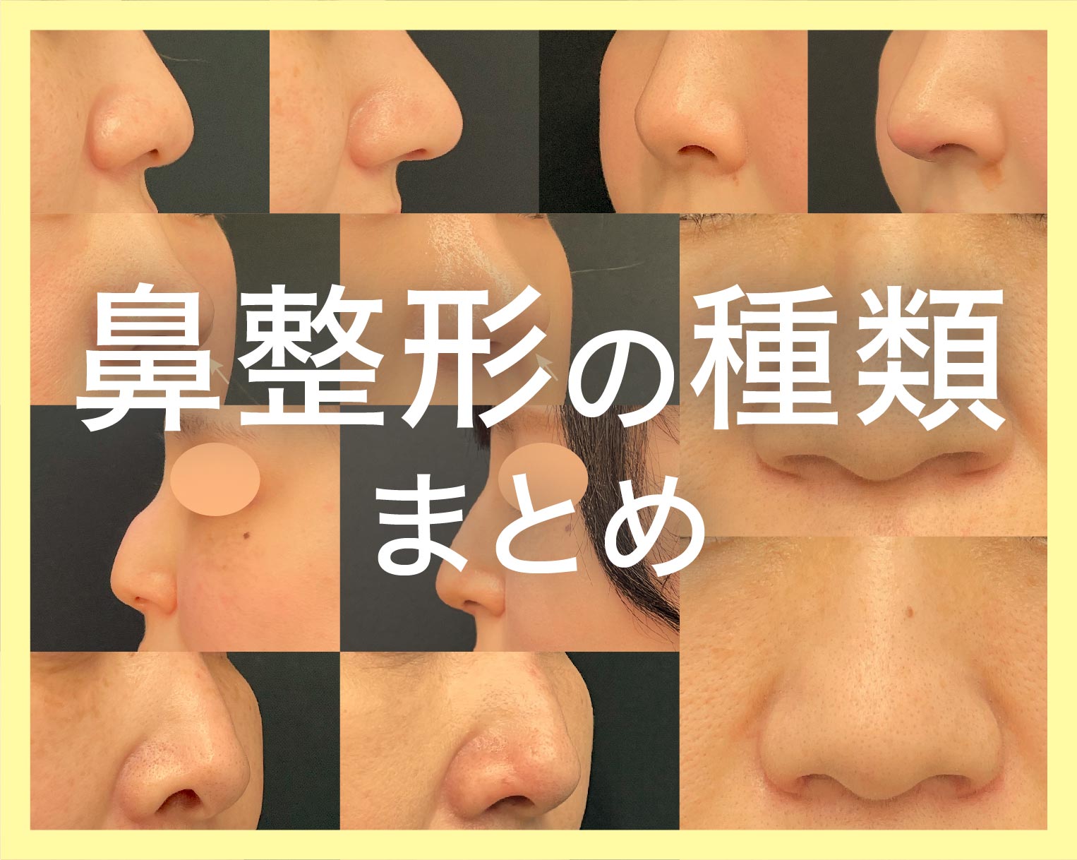 綺麗な鼻腔 鼻整形の種類について、お悩み別に症例を交えて徹底解説！ - 大宮東口院