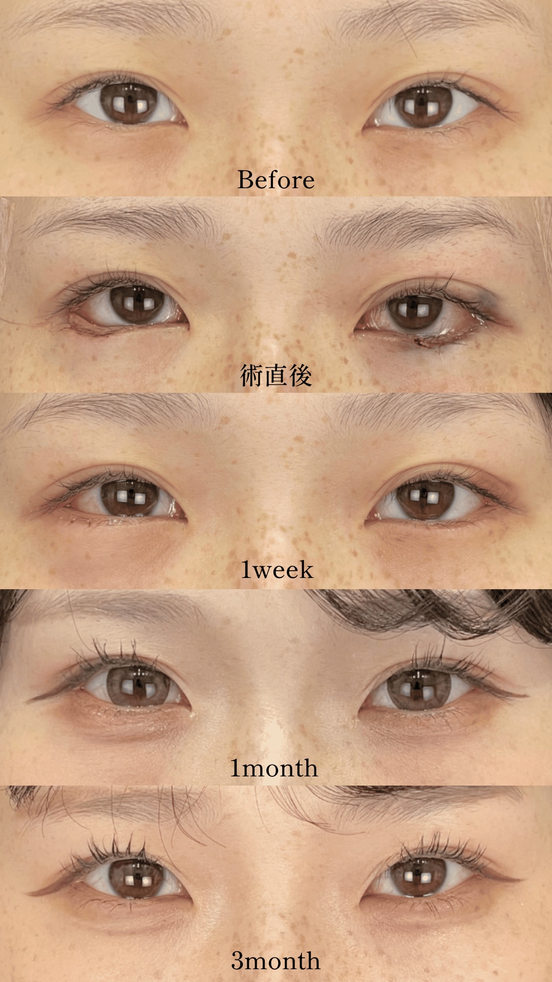 目尻切開＋下眼瞼下制