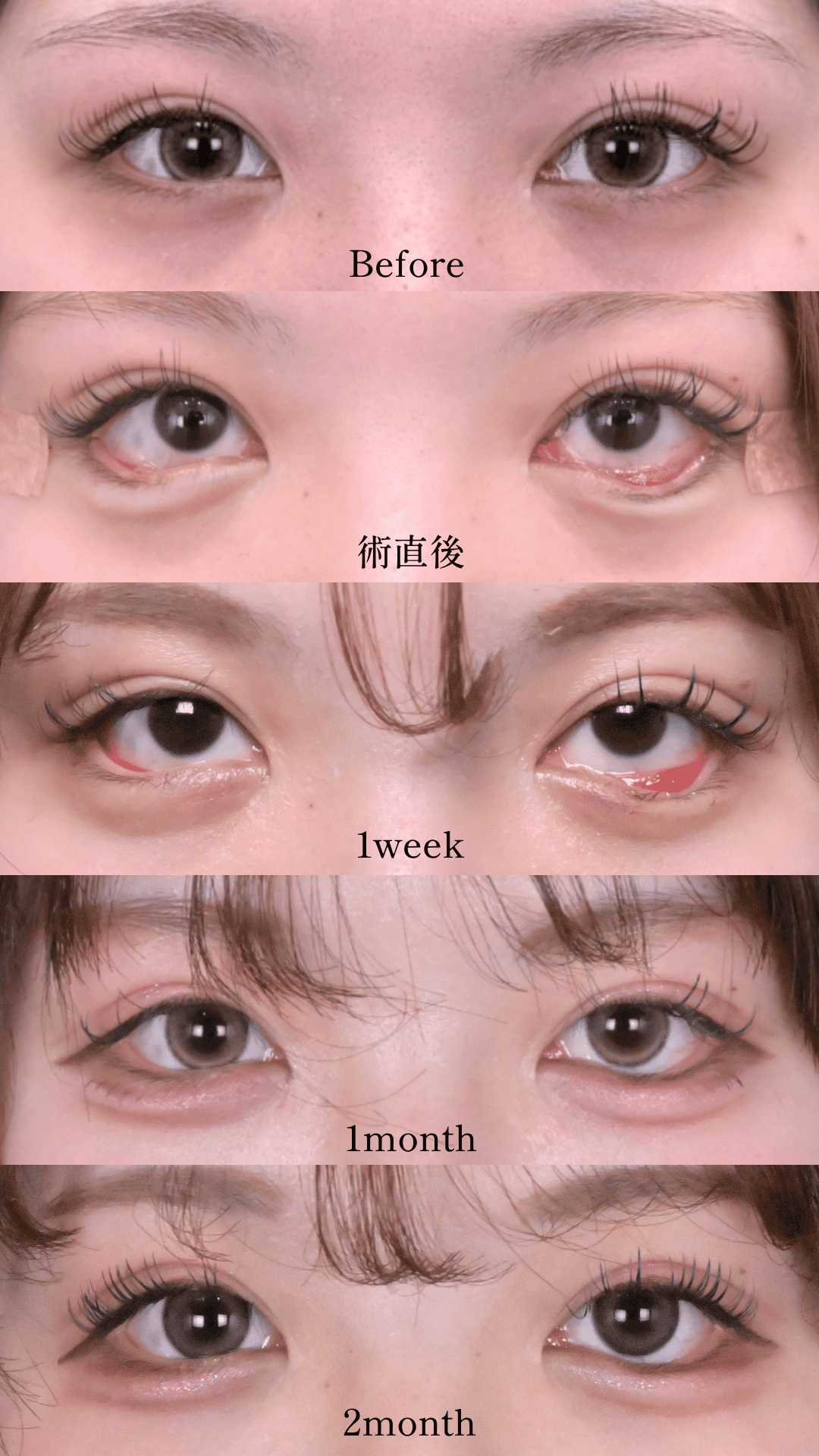 目尻切開＋下眼瞼下制