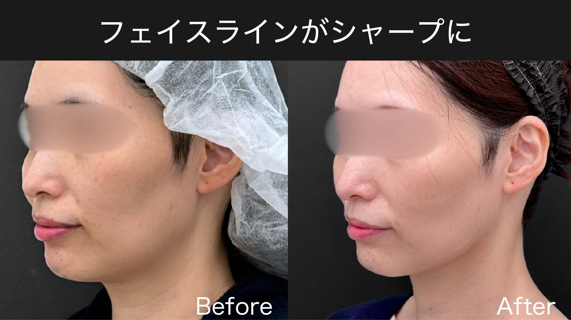シャープなフェイスラインに