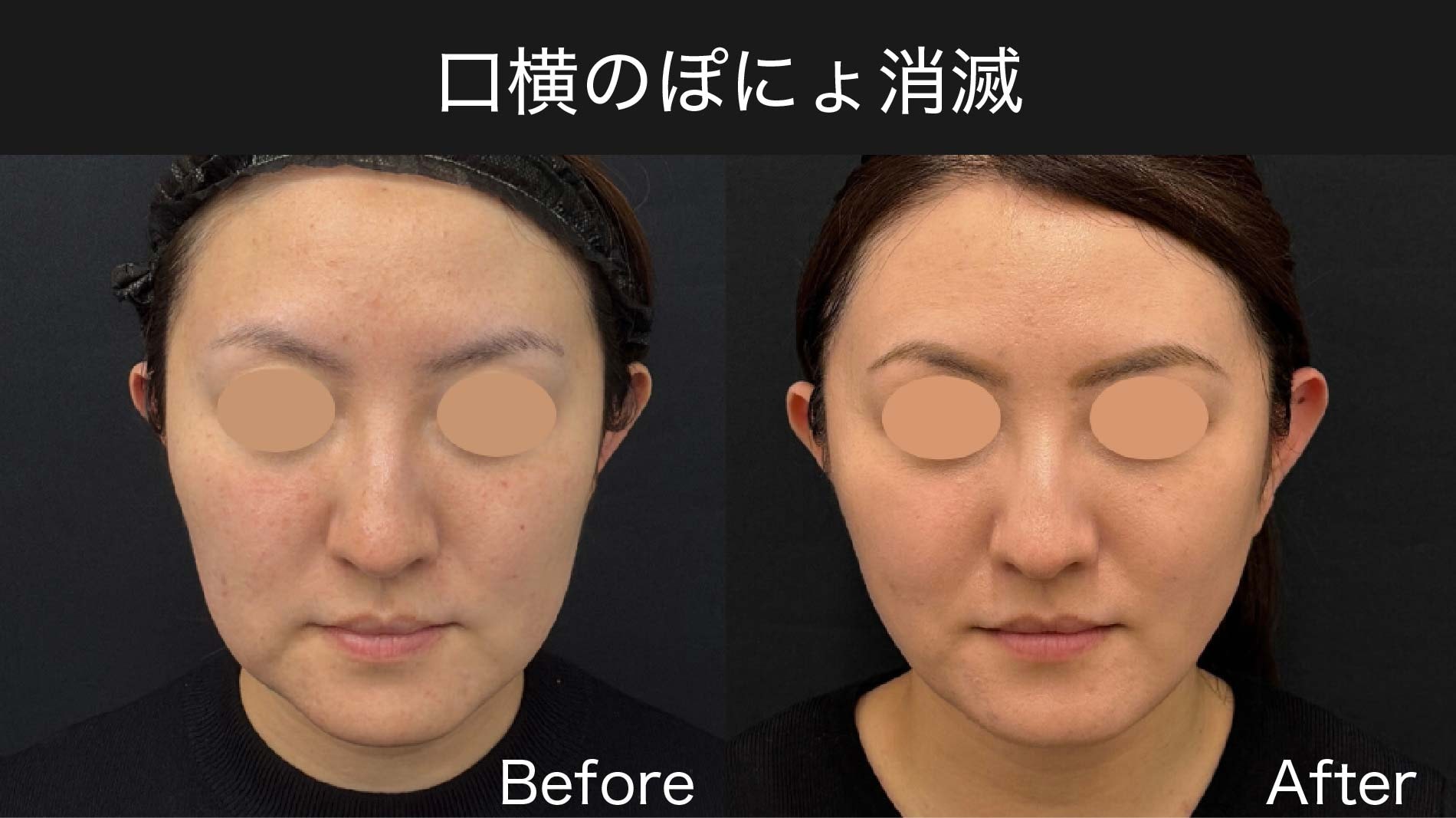 口横のぽにょ消滅