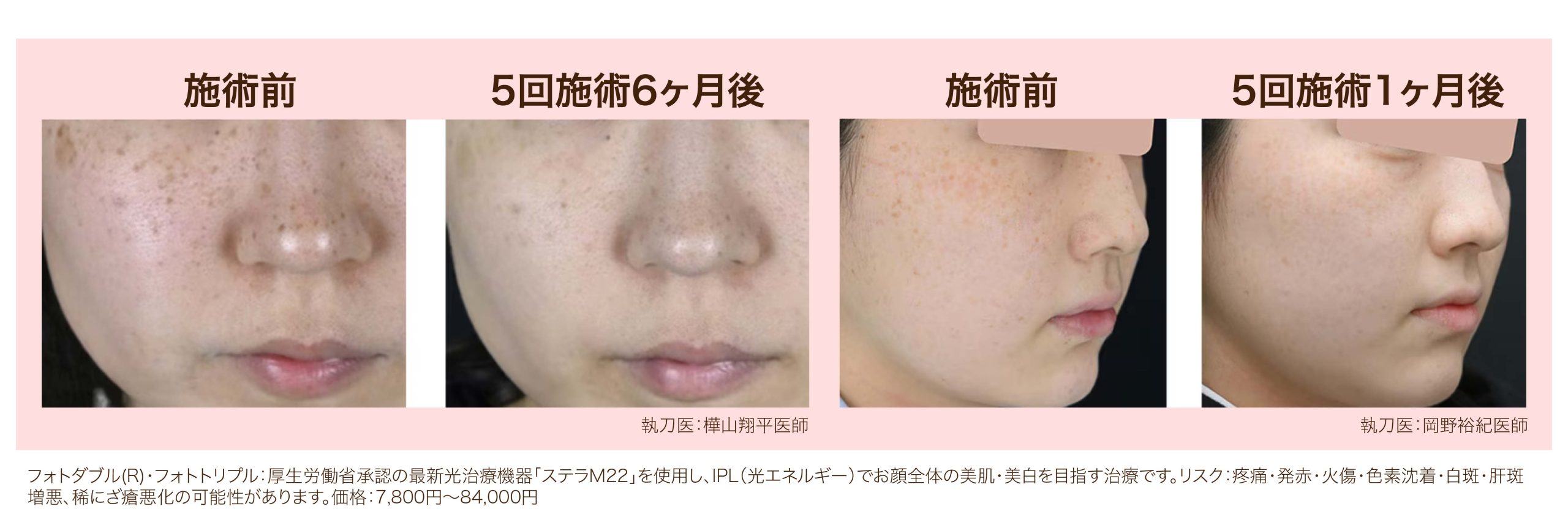 IPL光治療(フォトダブル・フォトトリプル)
