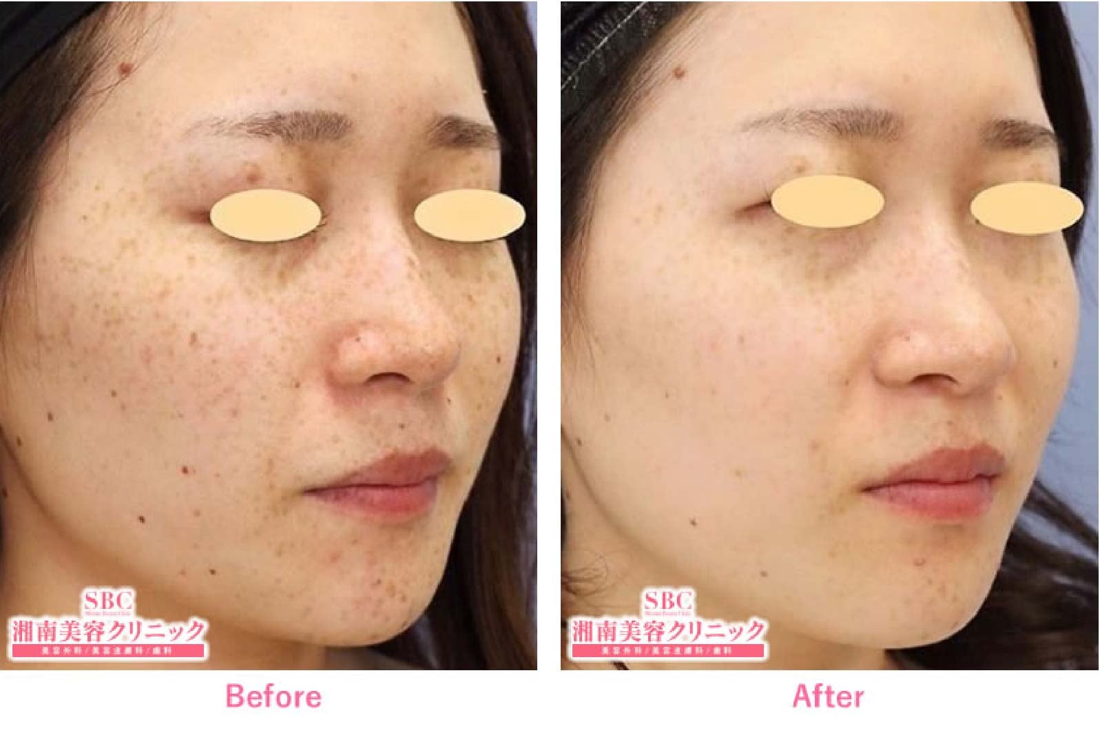 シミ・そばかす・くすみを撃退