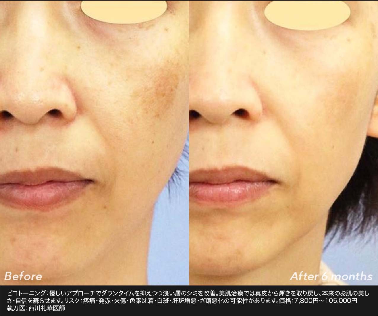 治療の難しい肝斑にも効果大◎