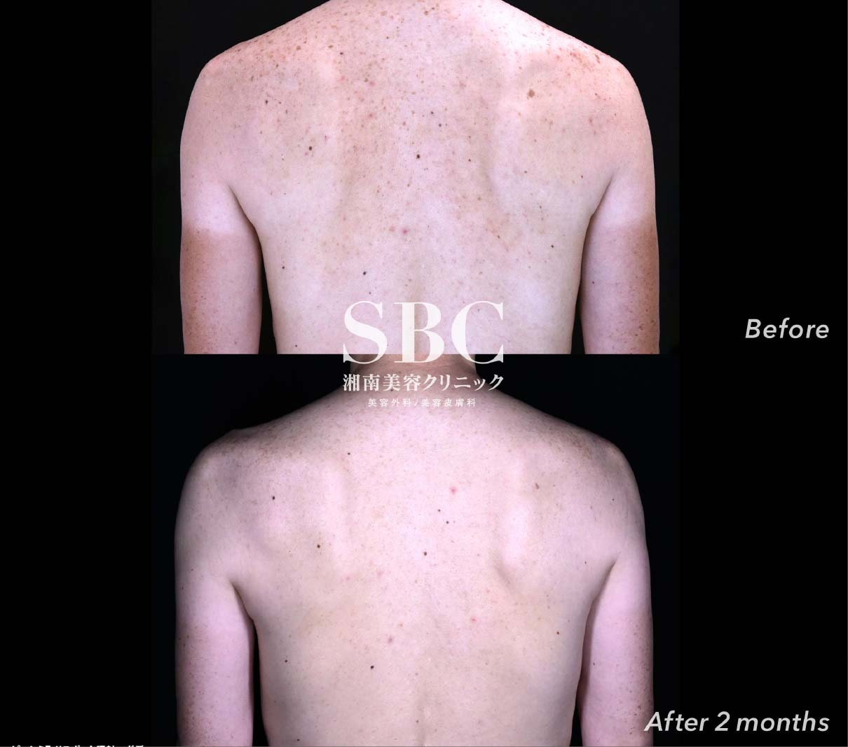 体のシミ取りもできちゃう！