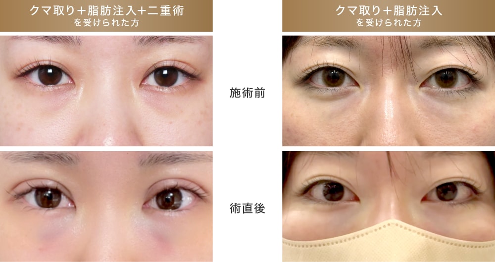 術前から手術直後
