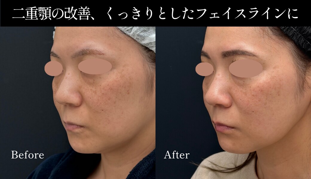 脂肪吸引注射と糸リフトの併用